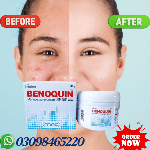 benoquin monobenzone cream in pakistan
